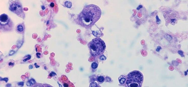 Vlastnosti priebehu cytomegalovírusovej infekcie u žien a spôsoby jej liečby