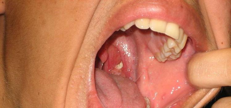 Holes in tonsils