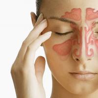Symptómy a liečba zápalu vedľajších nosových dutín